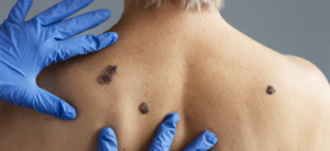 prevenzione-melanoma-centro-medico-medical-group-dermatologia-mappatura-nevi